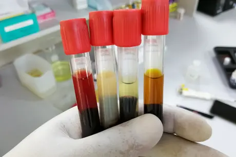 Bilüribin Testi Nedir